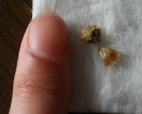 耳垢 りったんとの日々