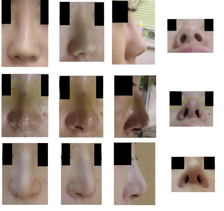 鼻尖縮小術（クローズ法）、鼻先軟骨移植、鼻孔縁挙上、舟型（I型）プロテーゼ隆鼻術_d0092965_071052.jpg