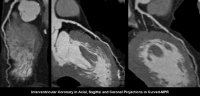 OsiriX がバージョンアップしました！_a0055913_0121725.gif