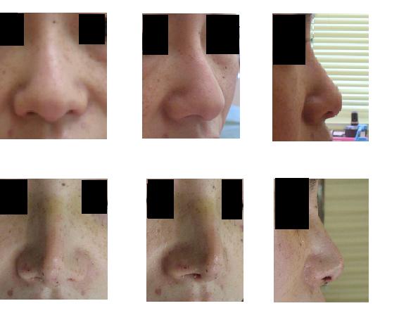 鼻尖縮小術、鼻プロテーゼ_d0092965_2333536.jpg