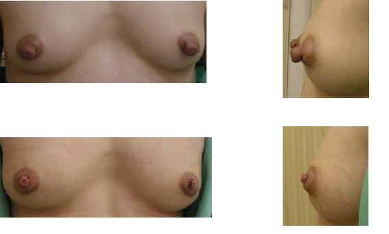 乳頭縮小術_d0092965_1262676.jpg