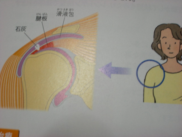 石灰沈着性腱板炎_b0076334_23225538.jpg