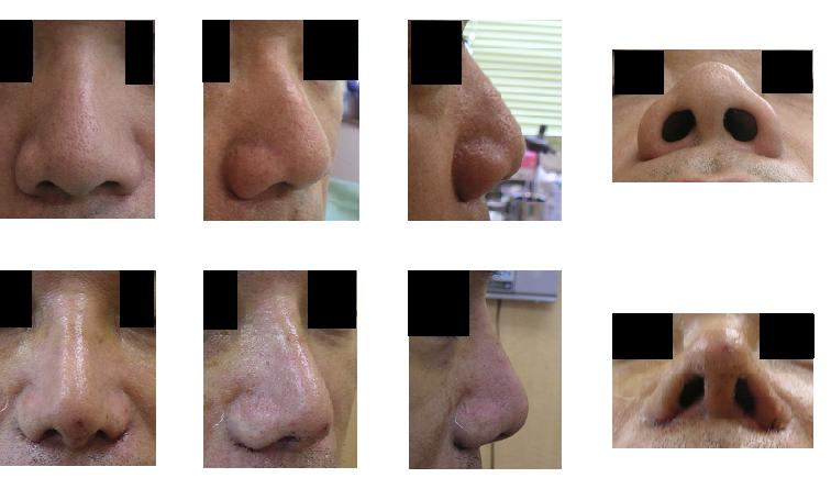 鼻尖縮小術、小鼻縮小術、プロテーゼ隆鼻術_d0092965_20445490.jpg