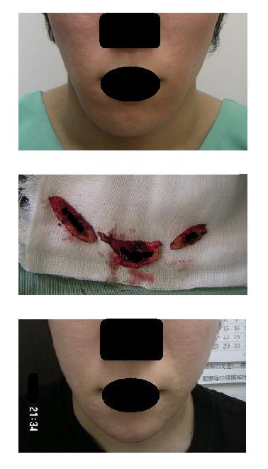 顎骨骨切り術：顎先短縮手術_d0092965_22451899.jpg
