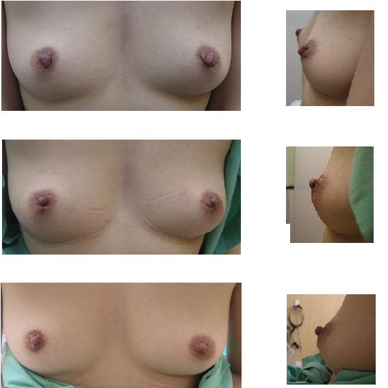 乳頭縮小_d0092965_012479.jpg