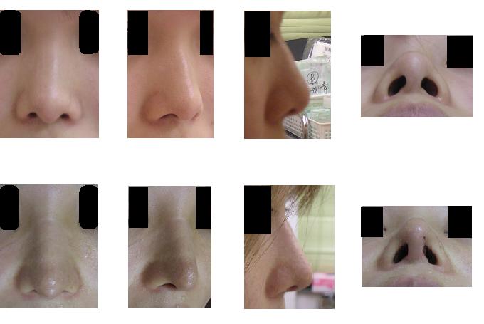 鼻中隔延長術、鼻尖縮小術（クローズ法）、舟型プロテーゼ隆鼻術_d0092965_16514859.jpg