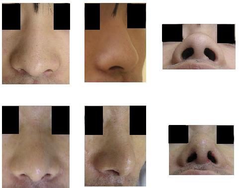 鼻尖縮小術（クローズ法）_d0092965_20583075.jpg