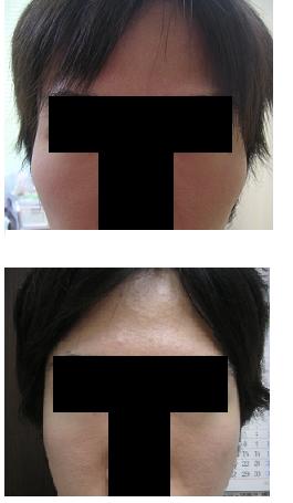 頬骨(きょうこつ)アーチリダクション=頬骨弓リダクション≒頬骨削り(切り)_d0092965_21383982.jpg