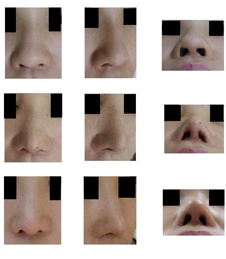鼻尖縮小術（クローズ法）_d0092965_23321442.jpg