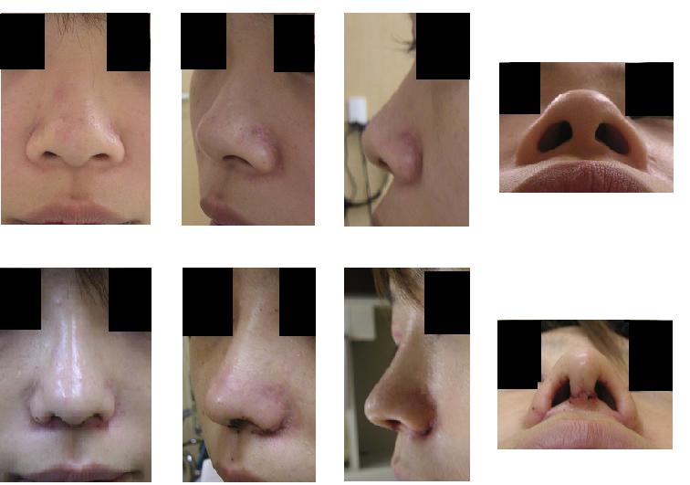 鼻中隔延長術、鼻尖縮小術、小鼻縮小術、鼻プロテーゼ_d0092965_20272631.jpg