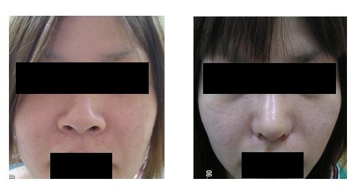 鼻中隔延長、鼻尖縮小（クローズ法）、小鼻縮小、プロテーゼ隆鼻術_d0092965_23501264.jpg
