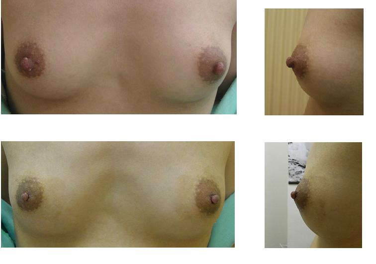 乳頭縮小術_d0092965_2422871.jpg