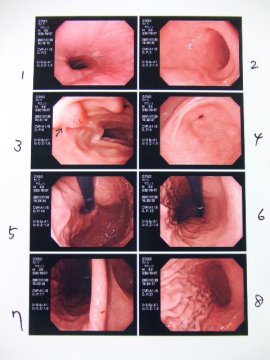 胃内視鏡フェチ_f0120102_19533449.jpg