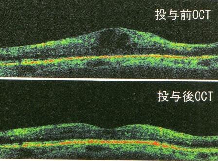 再び糖尿病網膜症について　その２　（糖尿病黄斑症について）_f0088231_15281085.jpg