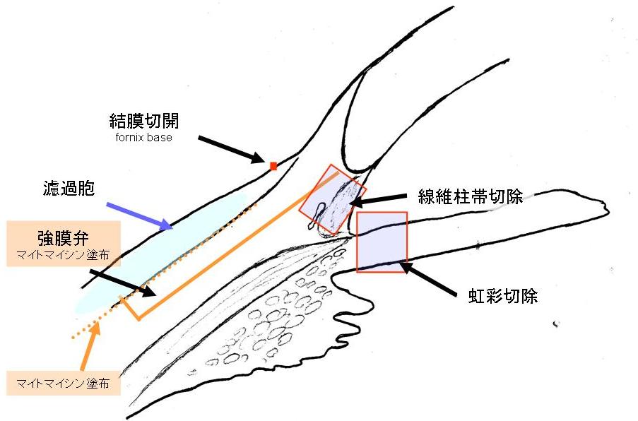 トラベクレクトミーについて_f0088231_1772121.jpg