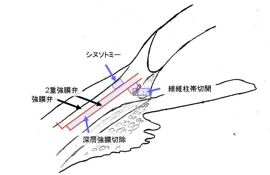 トラベクレクトミーについて_f0088231_7274248.jpg