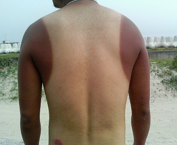 日焼け跡 鯉のぼり日記