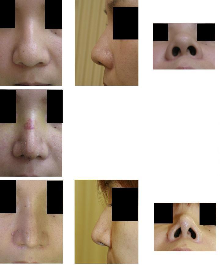 鼻尖縮小術術後20ヶ月_d0092965_01932.jpg
