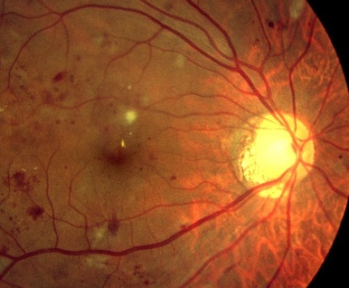 Images of 網膜色素線条症 JapaneseClass.jp