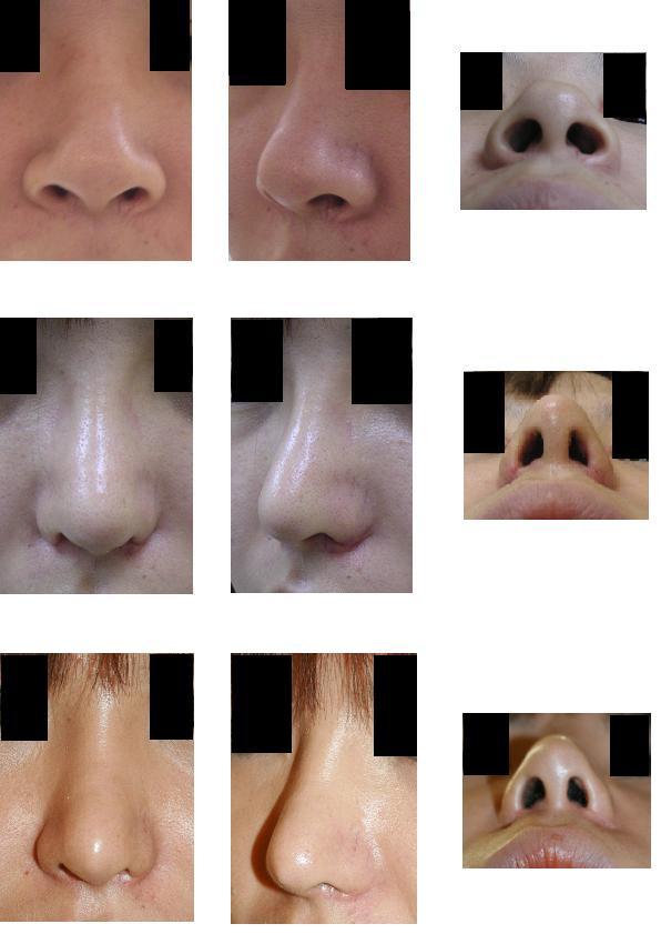 鼻中隔延長、鼻尖縮小（クローズ法）、小鼻縮小、プロテーゼ隆鼻術_d0092965_23331478.jpg