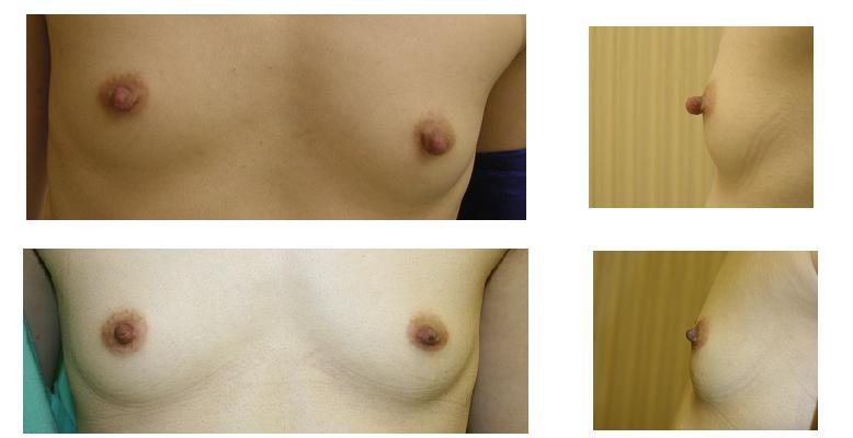 乳頭縮小術_d0092965_053747.jpg