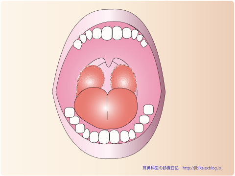 扁桃のお話し〜どんなときに手術が勧められるのか?〜_e0084756_1211480.gif