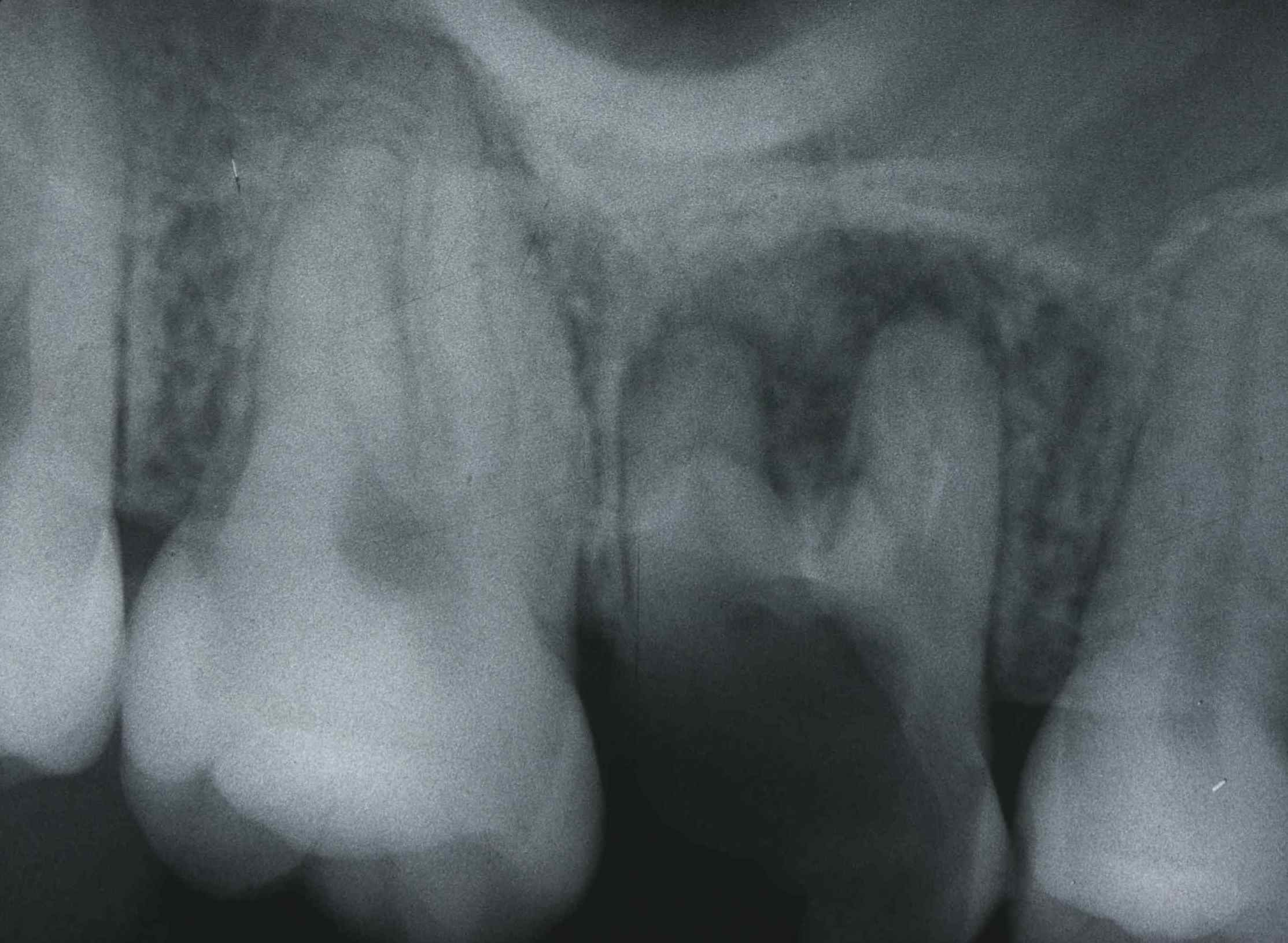 歯の移植２_b0076863_22162748.jpg