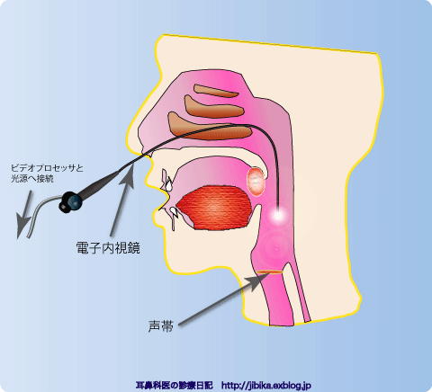 喉頭の内視鏡検査_e0084756_17592794.gif