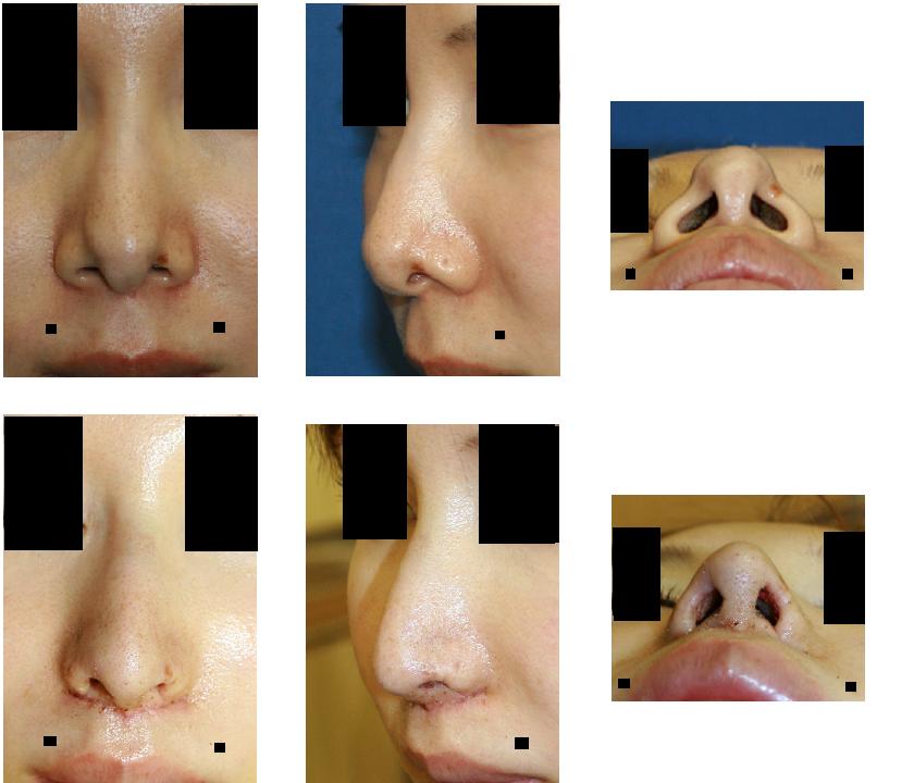 鼻尖縮小術（クローズ法）、小鼻縮小術、鼻孔縁下降術、人中短縮術_d0092965_23202877.jpg