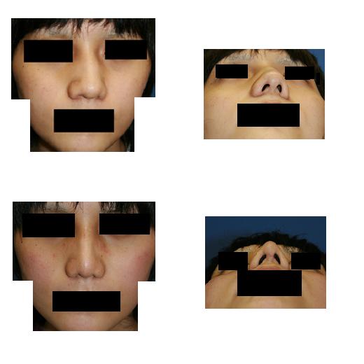 斜鼻変形治療、鼻根縮小術、鼻尖縮小術_d0092965_143179.jpg