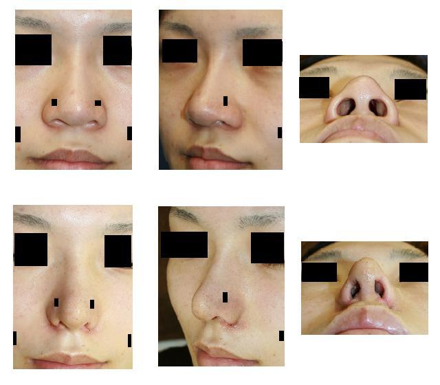 鼻尖縮小術、小鼻縮小術、鼻口唇角形成術_d0092965_238654.jpg