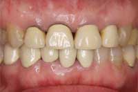 前歯の審美的修復１_f0154626_17254764.jpg
