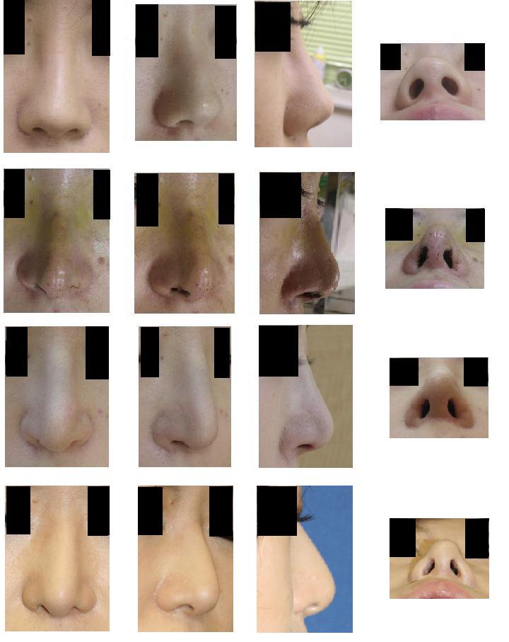鼻尖縮小術（クローズ法）、鼻先軟骨移植、鼻孔縁挙上、舟型（I型）プロテーゼ隆鼻術_d0092965_21233325.jpg
