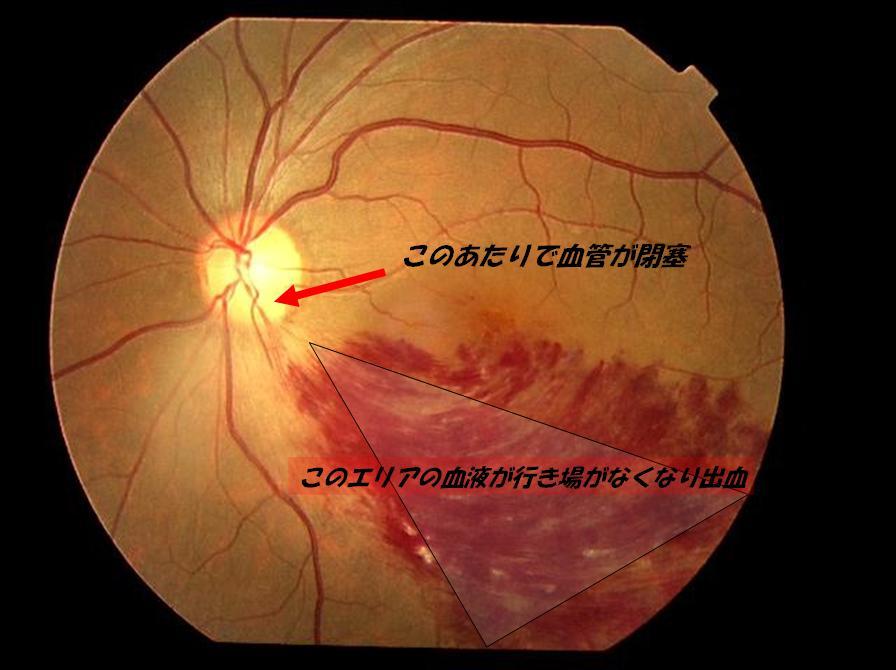 眼底出血 その1_f0088231_17573847.jpg