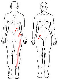 ヘルニアと診断された大腰筋と小臀筋の筋筋膜性疼痛症候群_b0052170_1810977.jpg