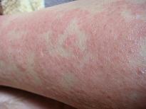 ヘルペス 帯状癒疹 足立区西新井駅前の皮膚科 アース皮ふ科クリニック