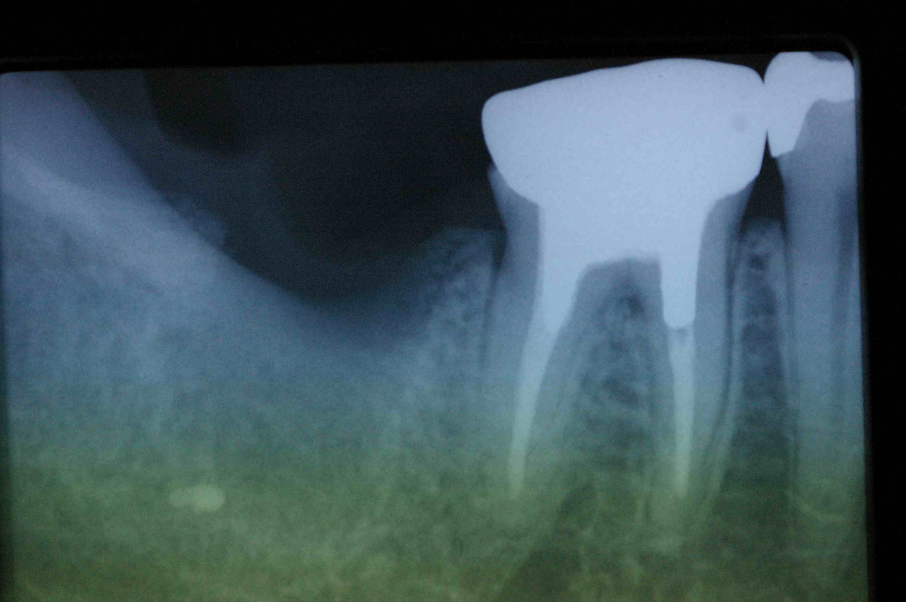 歯の移植３_b0076863_21561839.jpg
