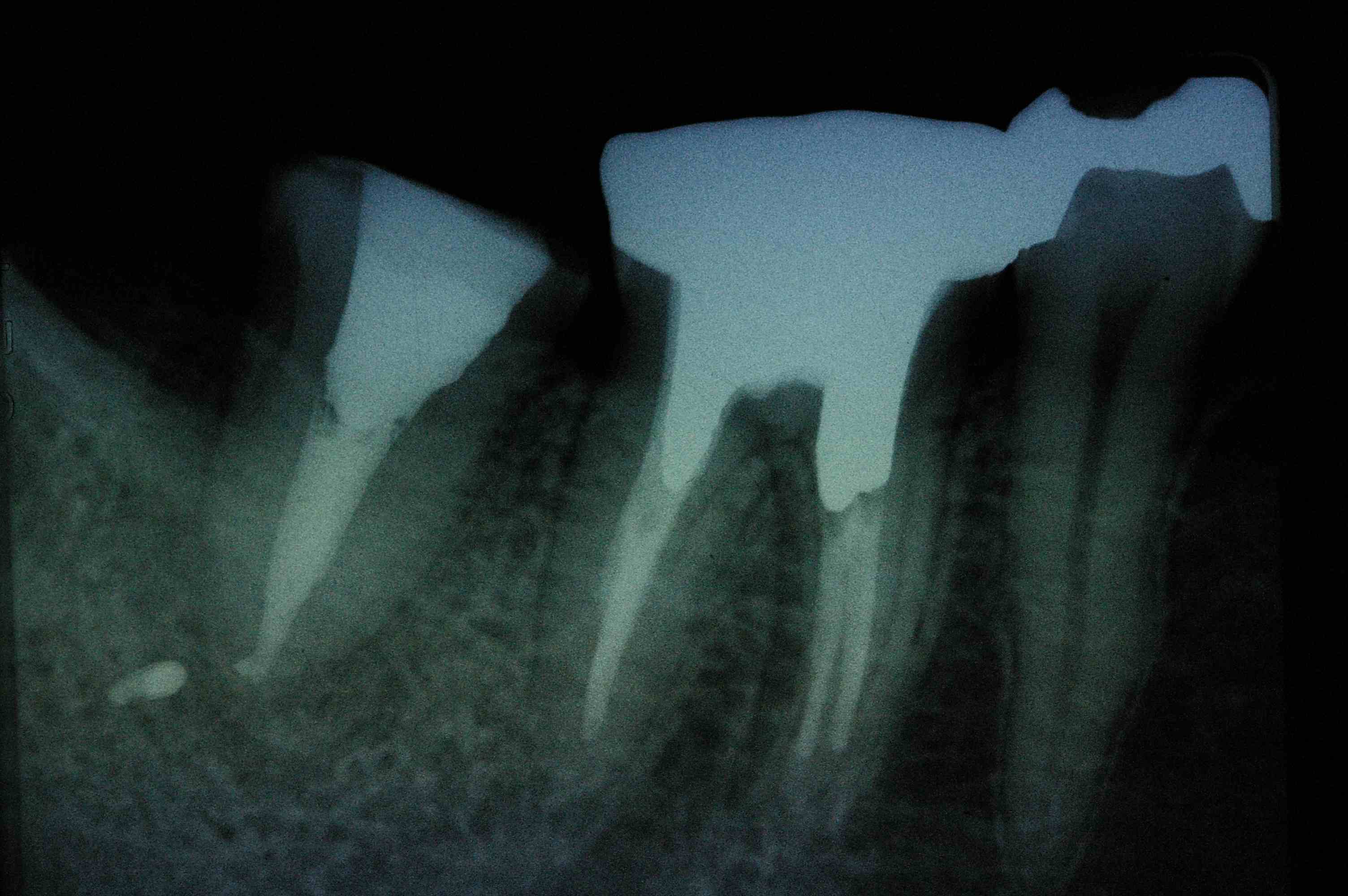 歯の移植３_b0076863_2157916.jpg