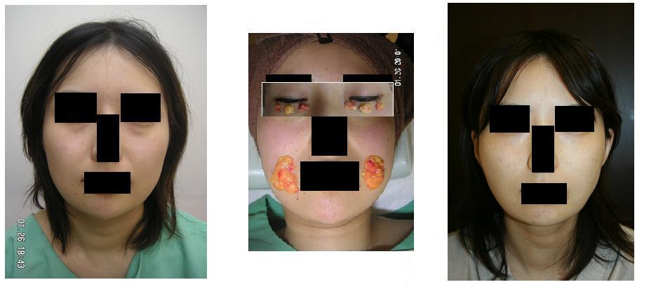 下瞼脂肪取り、バッカルファット摘出術_d0092965_22415291.jpg