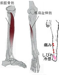 拇趾背屈力低下は神経麻痺ではありません_b0052170_1954580.jpg