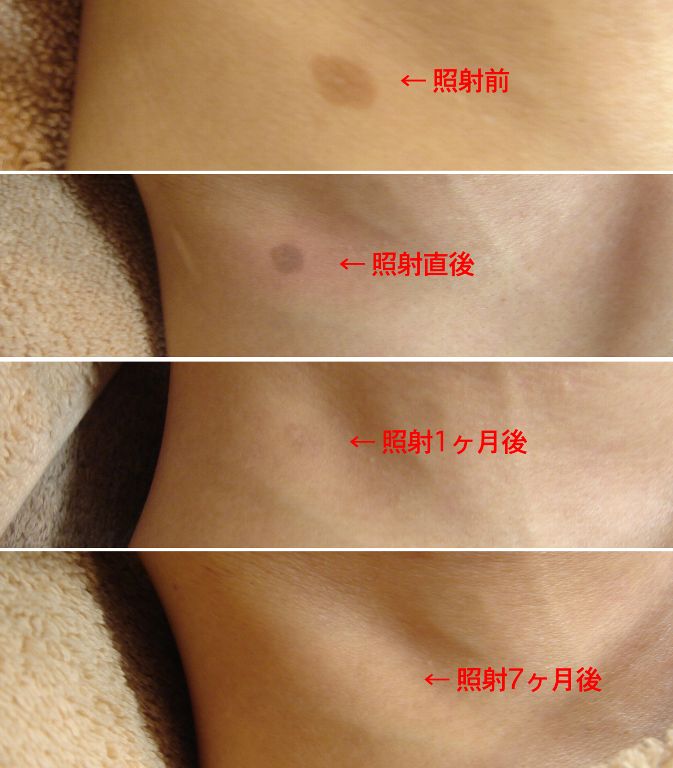 ドクタータカハシのスキンケア 脱毛 エステ 永久脱毛 スキンケア ドクタータカハシ キャンペーン情報 スタッフブログ 東日本版 ドクタータカハシのスキンケア 脱毛 エステ 永久脱毛 スキンケア ドクタータカハシ キャンペーン情報 スタッフブログ 東日本版