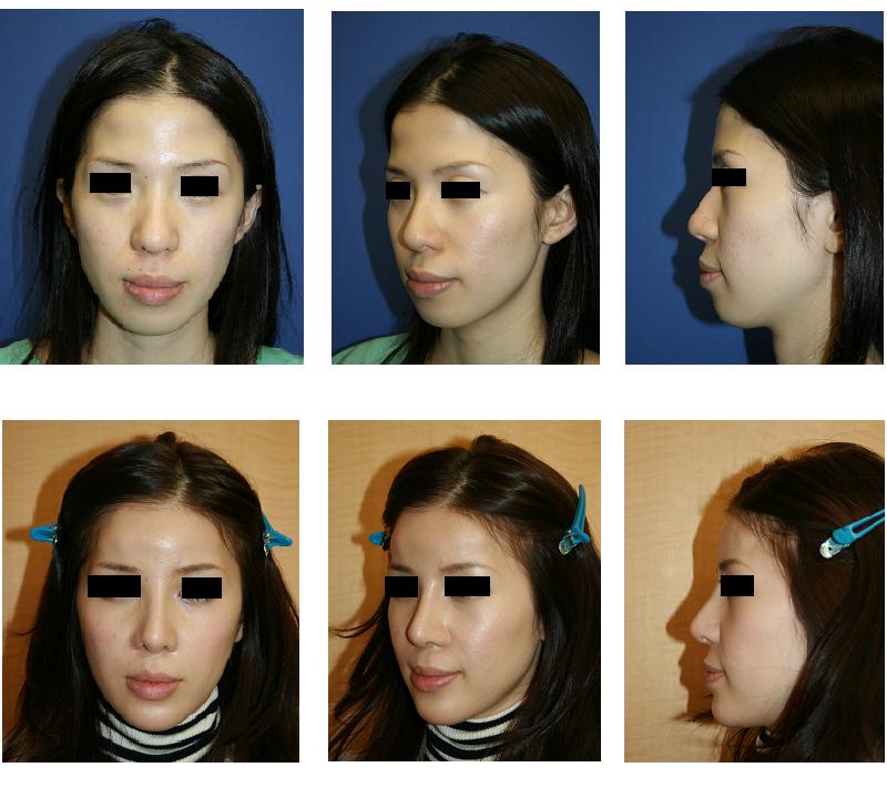 額形成術、鼻プロテーゼ、鼻尖縮小術、鼻翼基部プロテーゼ（ほうれい線プロテーゼ）、顎プロテーゼ_d0092965_035168.jpg