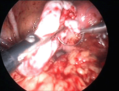 内膜症の治療はどうすれば良い Bl Og Obstetrics And Gynecology