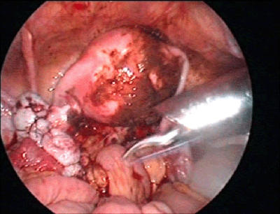 内膜症の治療はどうすれば良い Bl Og Obstetrics And Gynecology