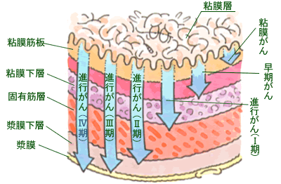 Oさんの胃がん_e0097212_18413533.gif