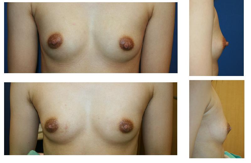 乳頭縮小形成術(単純切除法)_d0092965_02992.jpg