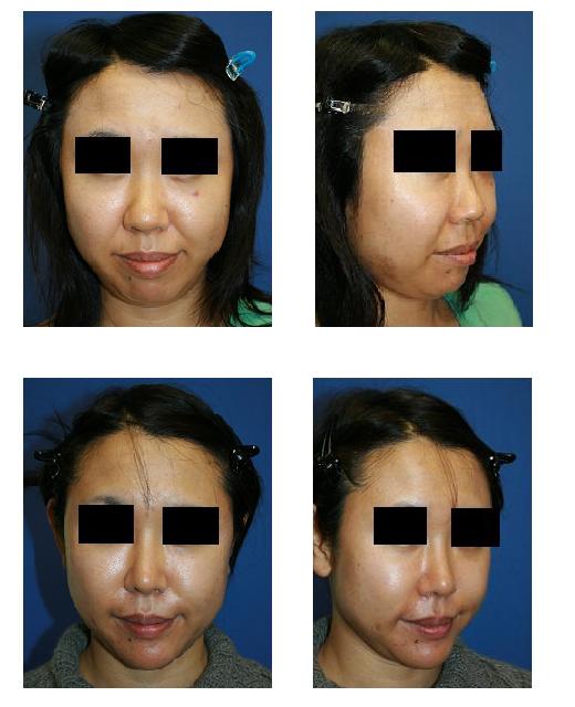 顔面脂肪再配置術（ＦＡＭＩ法）、顎プロテーゼ、鼻尖縮小術、プロテーゼ隆鼻術_d0092965_0425171.jpg