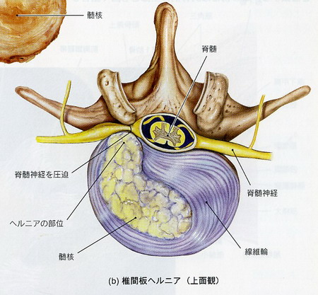 椎間板ヘルニア_b0140293_2136365.jpg