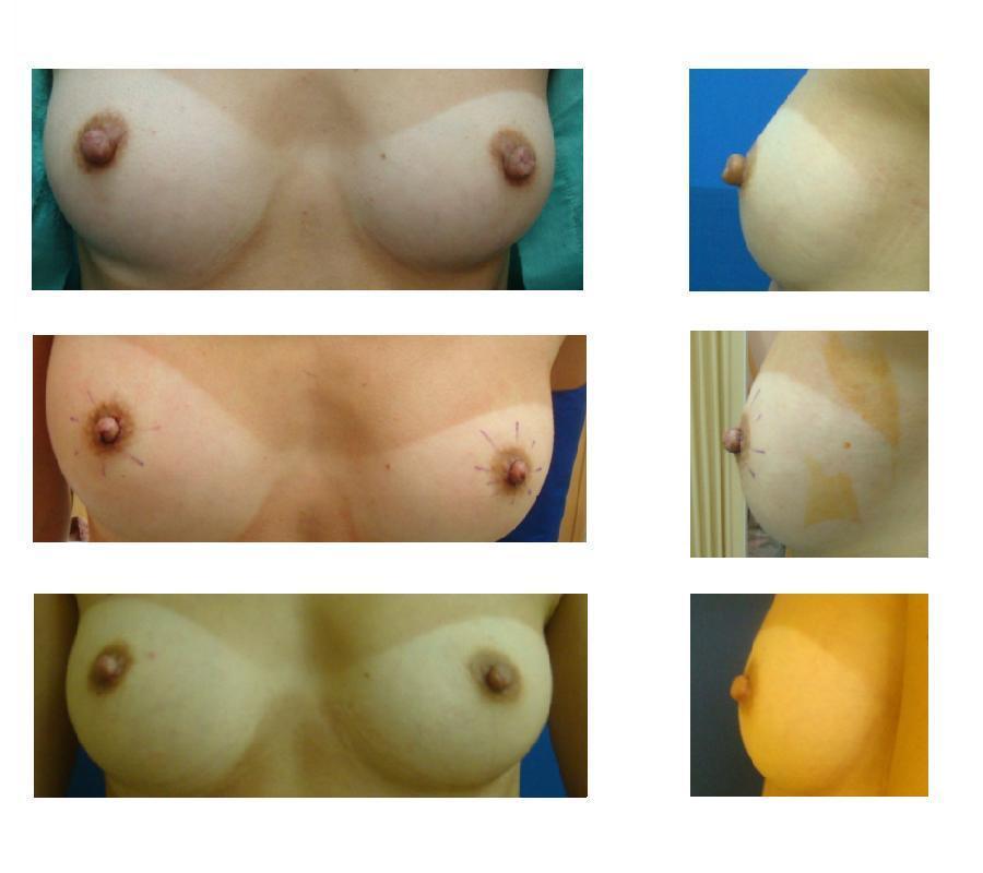 乳頭縮小術〈若先生)_d0092965_20473110.jpg
