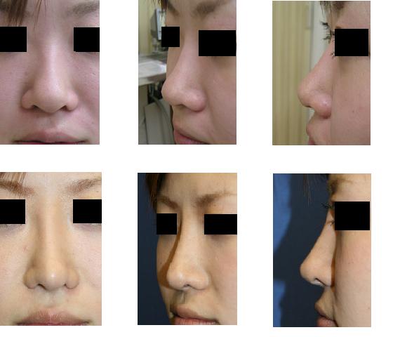 鼻尖縮小術、プロテーゼ隆鼻術、小鼻縮小術、耳軟骨移植術 _d0092965_232217100.jpg